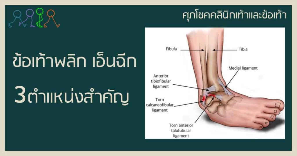 ข้อเท้าพลิก เอ็นฉีก 3 ตำแหน่งสำคัญที่พบได้บ่อย ทำยังไง อันตรายไหม